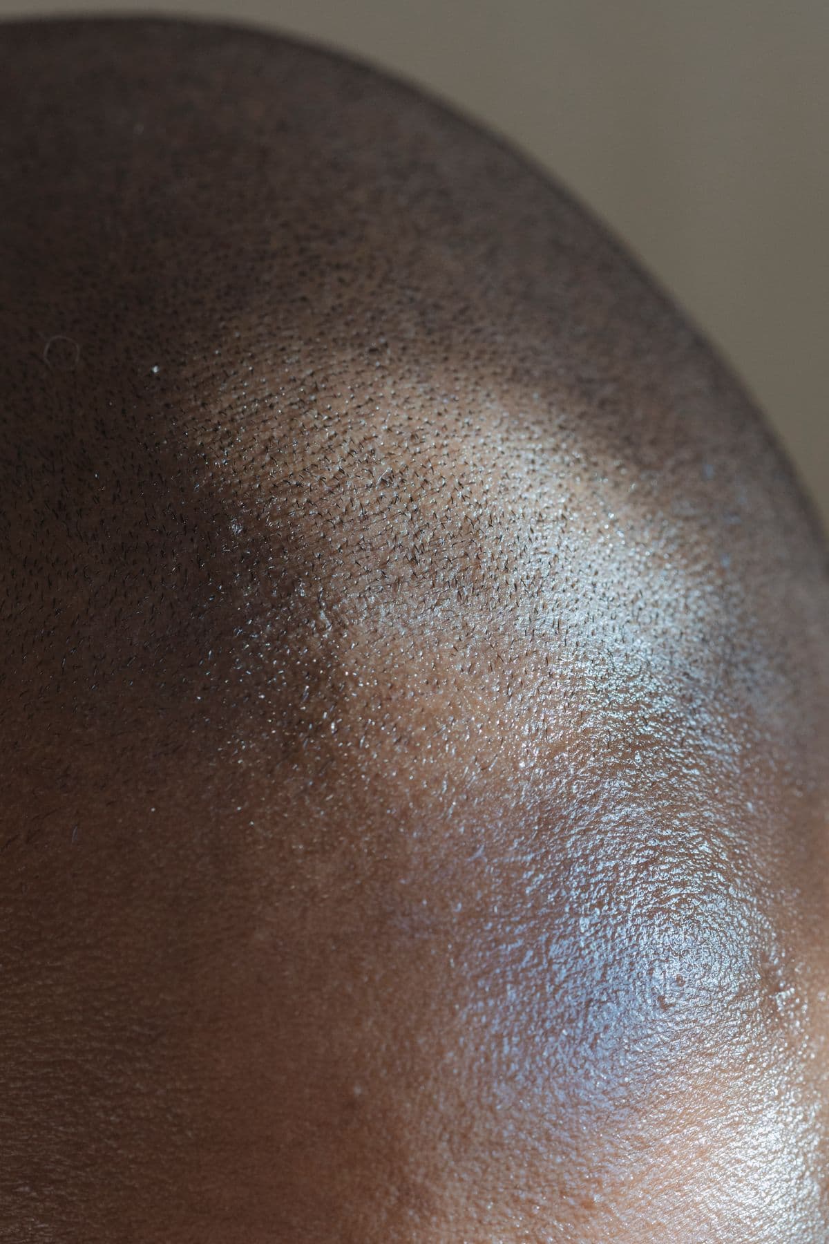 Scalp Pigmentation